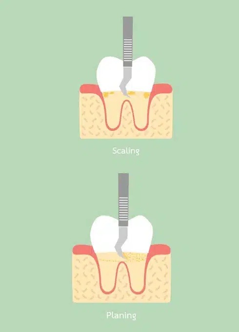 Scaling and Root Planing