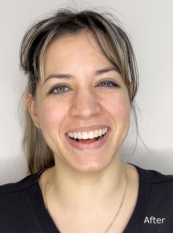 Smile makeover after