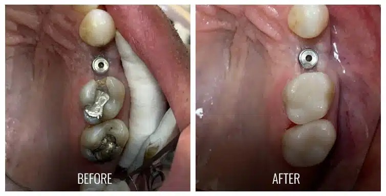 Onlays in Plantation, FL