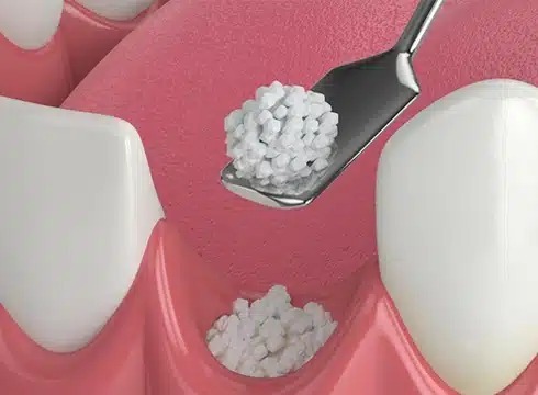 Bone Grafting in Plantation, FL