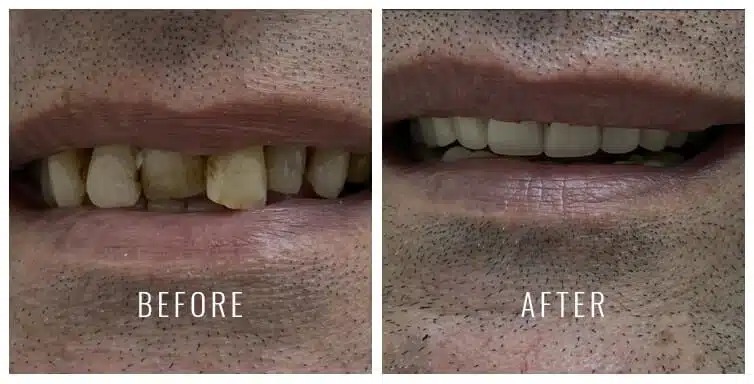 Dentures in Plantation, FL