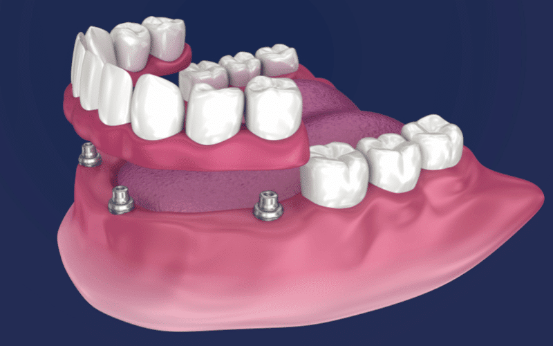 All-on-4-Implant