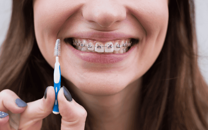 Whiten Teeth with Braces