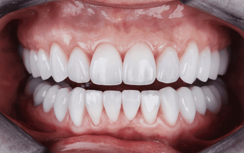 Porcelain Veneers Harmful to Teeth