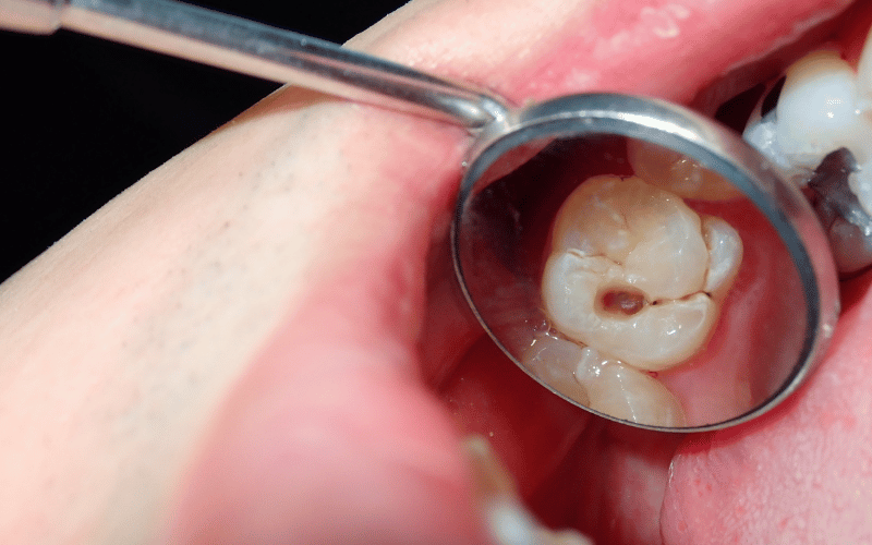 Reverse Cavities Without Dentist