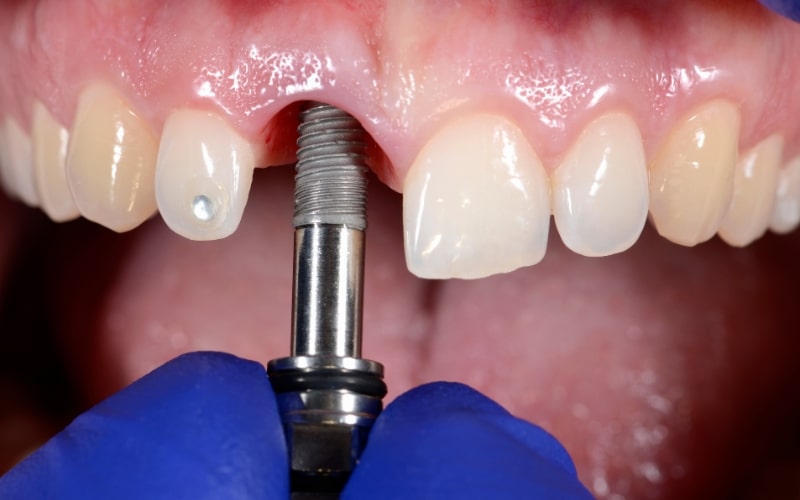 Dental Implants Bone Loss